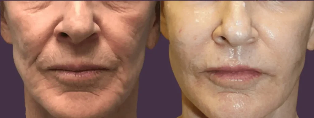 РФ лифтинг в Торревьеха